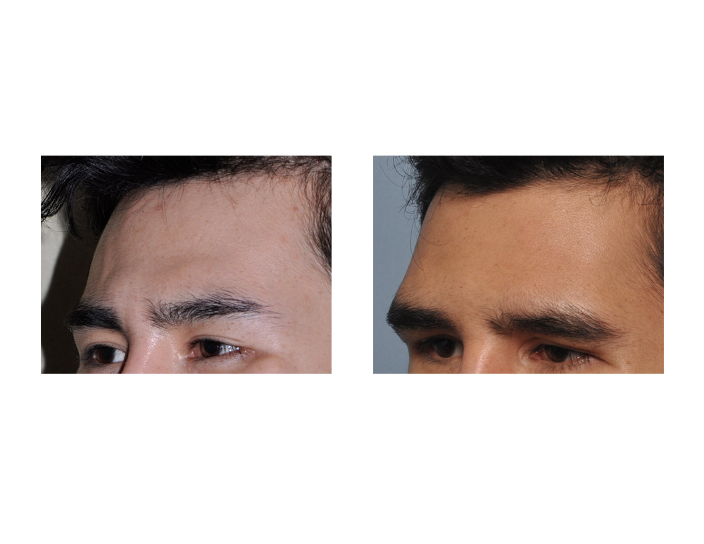 Custom-Forehead-Implant-result-oblique-view-Dr-Barry-Eppley-Indianapolis.jpg