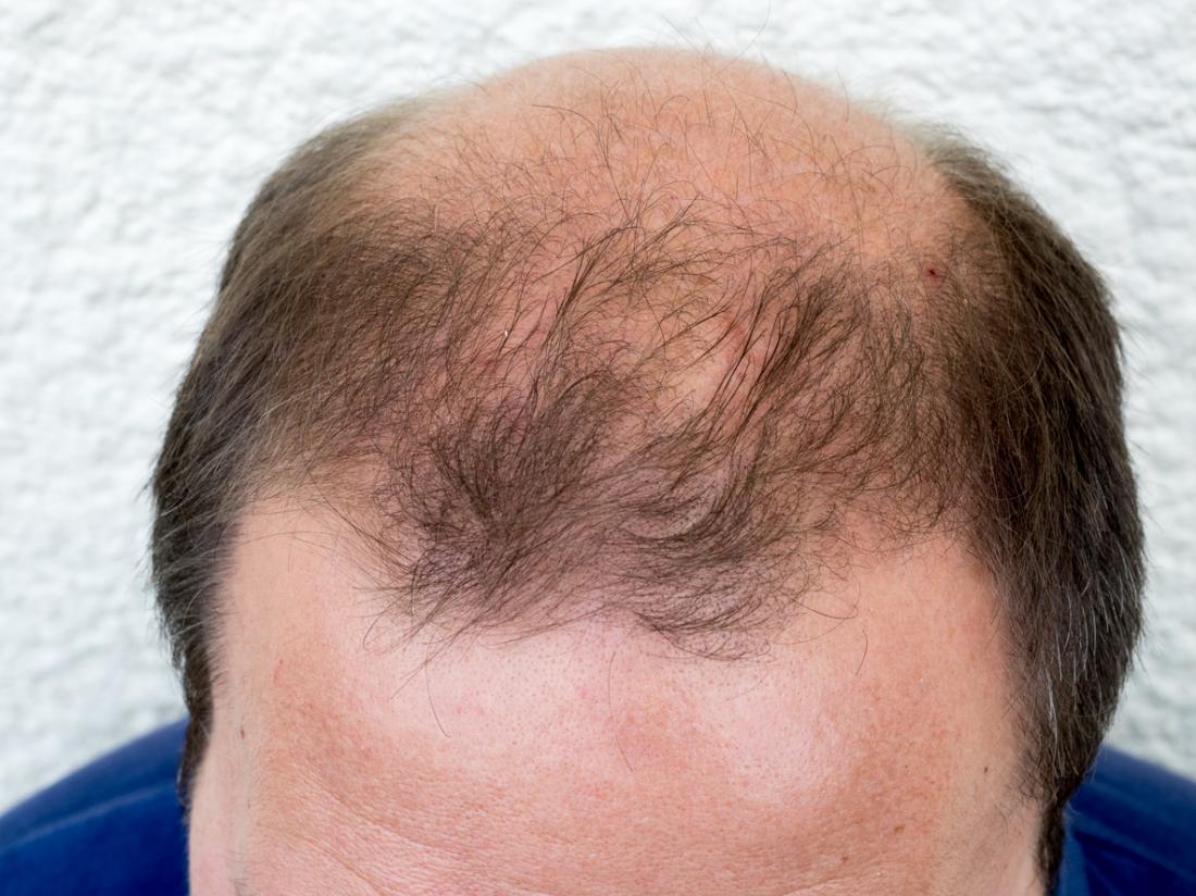 male-pattern-baldness.jpg