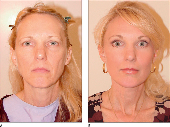 Facelift with SMAS Flaps | Clinical Gate