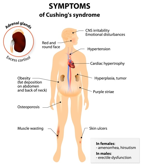 Cushing%27s_Syndrome_shutterstock_286083608_(1).jpg
