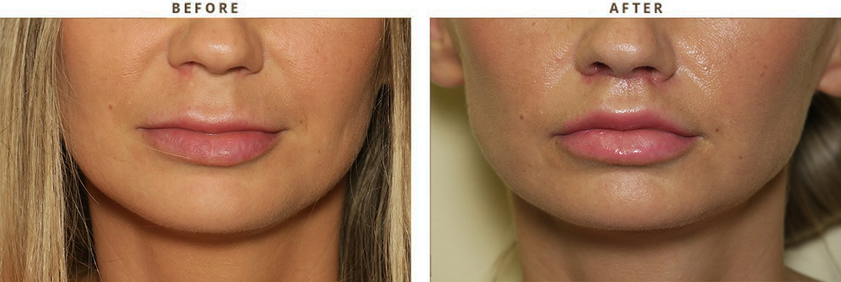 lip-lift-before-and-after-pictures-0018.jpg