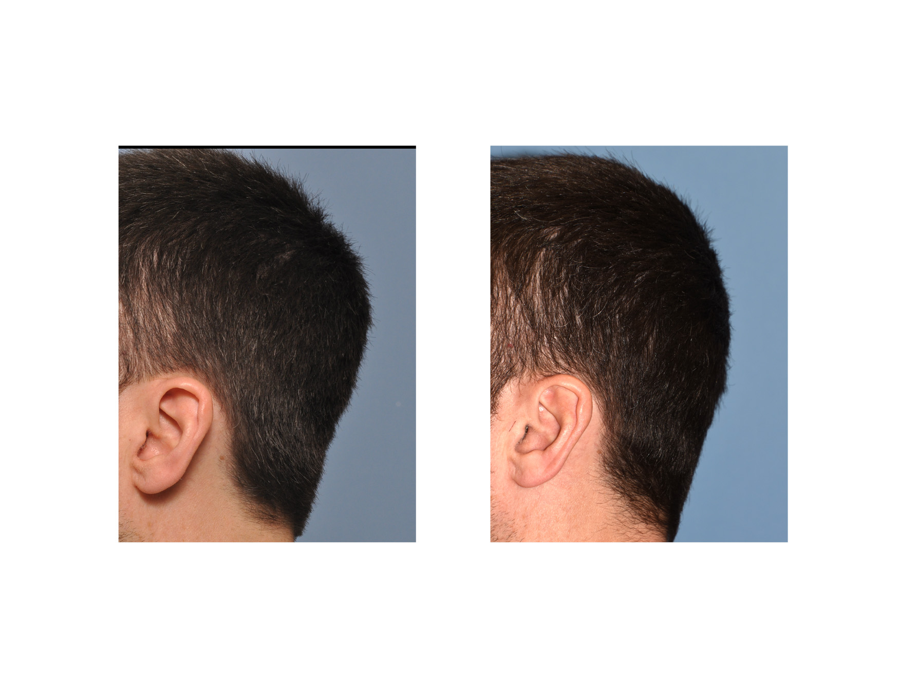 Occipital-Skull-Reduction-result-left-side-view-Dr-Barry-Eppley-Indianapolis.jpg