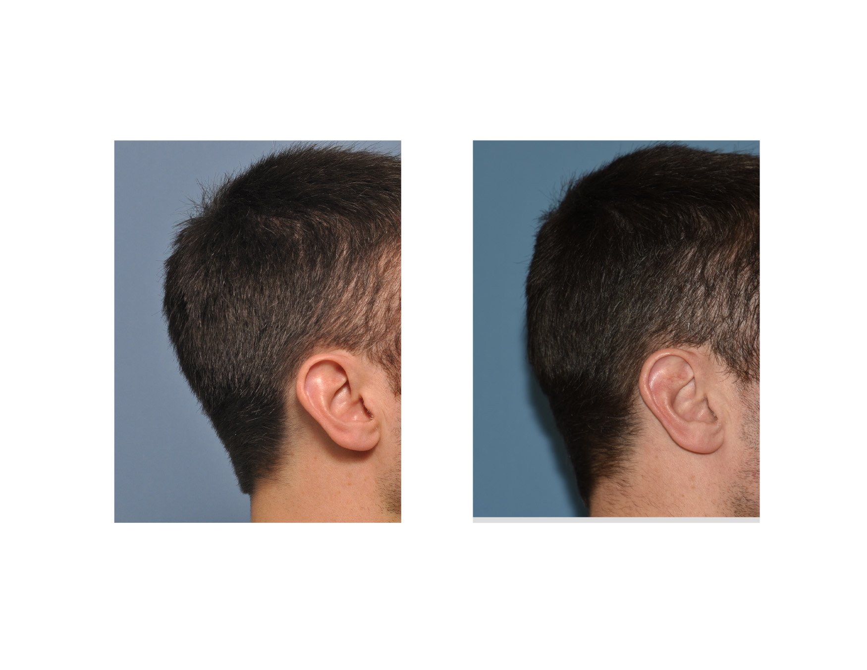 Occipital-Skull-Reduction-result-right-side-view-Dr-Barry-Eppley-Indianapolis.jpg