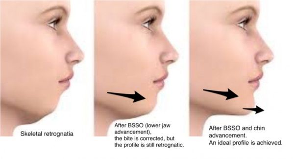 Mentoplasty (Chin Surgery): Types, Cost and Complications (With ...