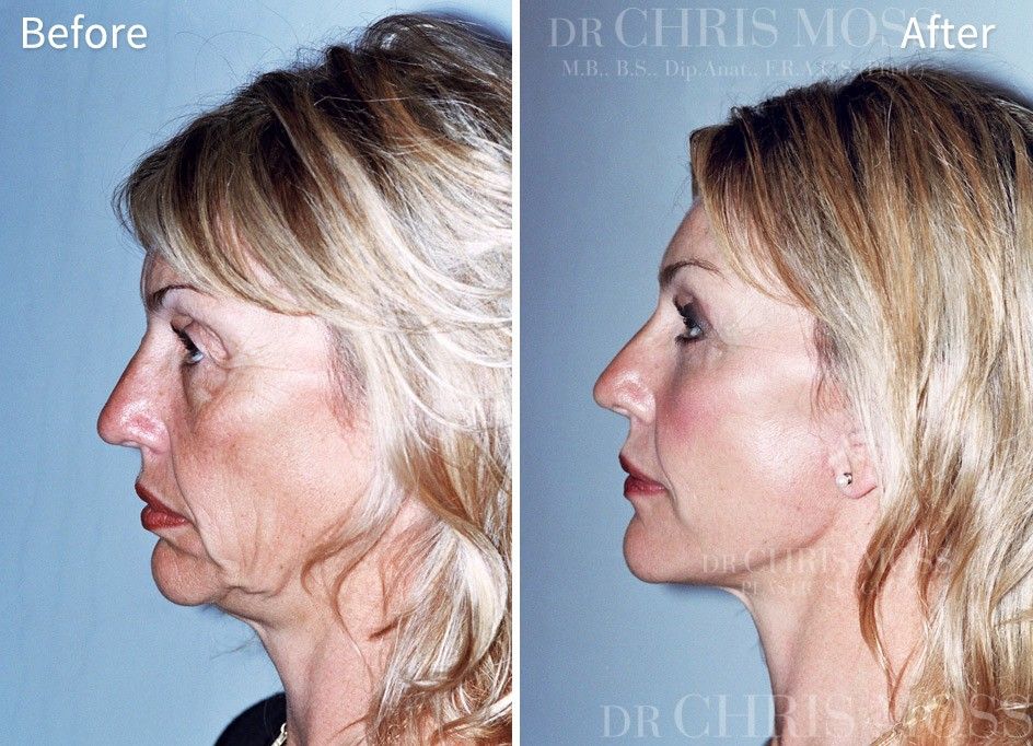 Face Lift Melbourne | Facial Rejuvenation | Face lift surgery, Face  fillers, Mini face lift
