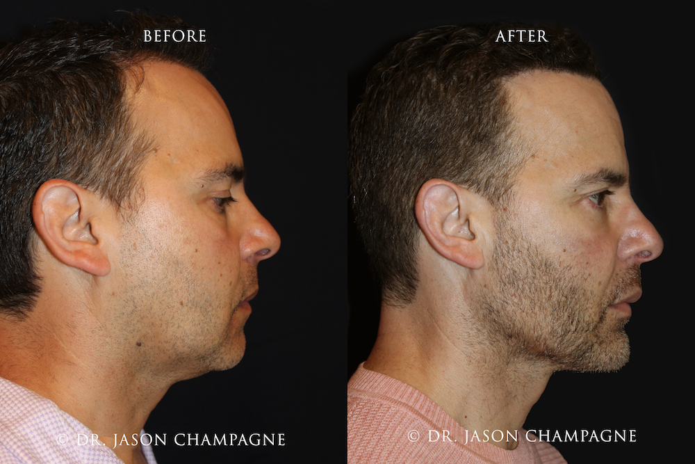 Custom Jaw and Chin Implants | Beverly Hills Plastic Surgeon - Dr ...