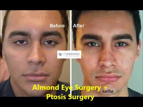 Canthoplasty Surgery | What is it? | Dr. Taban - Beverly Hills