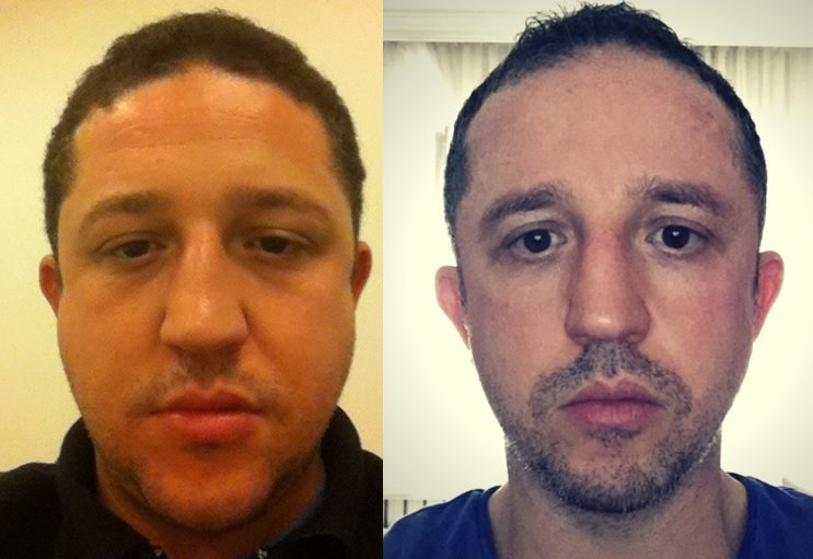 fat-face-chiseled-face-before-after.jpg