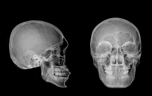 very-good-quality-x-ray-image-of-normal-human-skull-front-view-and-side-view-process-in-normal.jpg