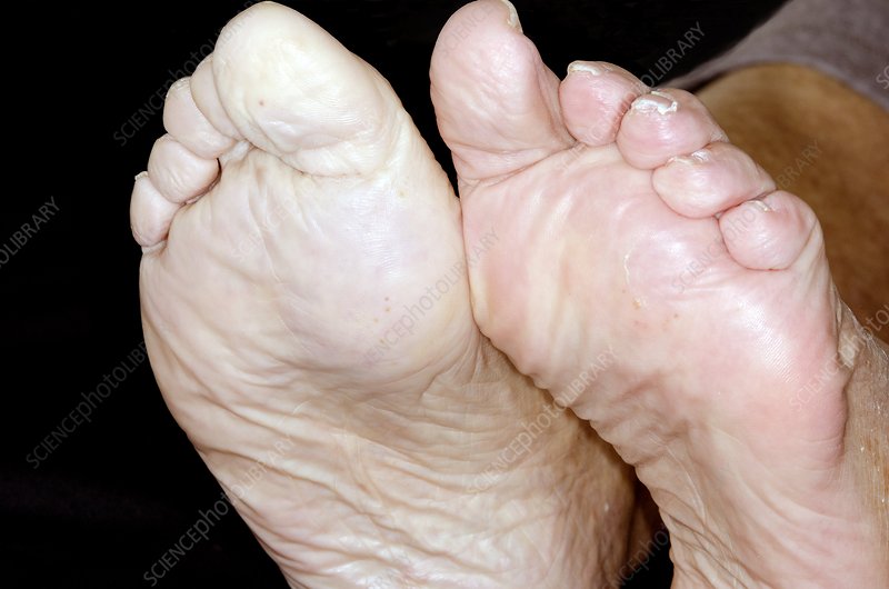Image result for pale foot