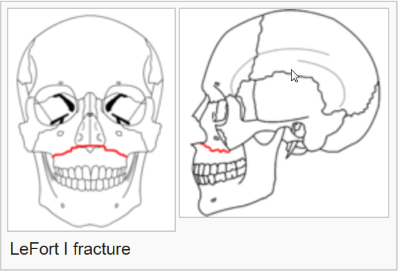Le%2520Fort%2520fracture%2520of%2520skull%2520-%2520Wikipedia%2C%2520the%2520free%2520encyclopedia_2014-07-22_16-56-35.png
