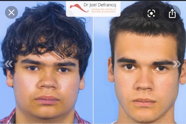 On the before picture he suffered from short face syndrome(his maxilla  wasnt downward enough) it was fixed by lowering the maxilla but isnt that a  downward maxilla abad thing? You can clearly