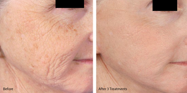 microneedling-with-prp-before-and-after.jpg