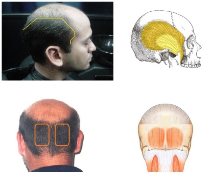 Alopecia2