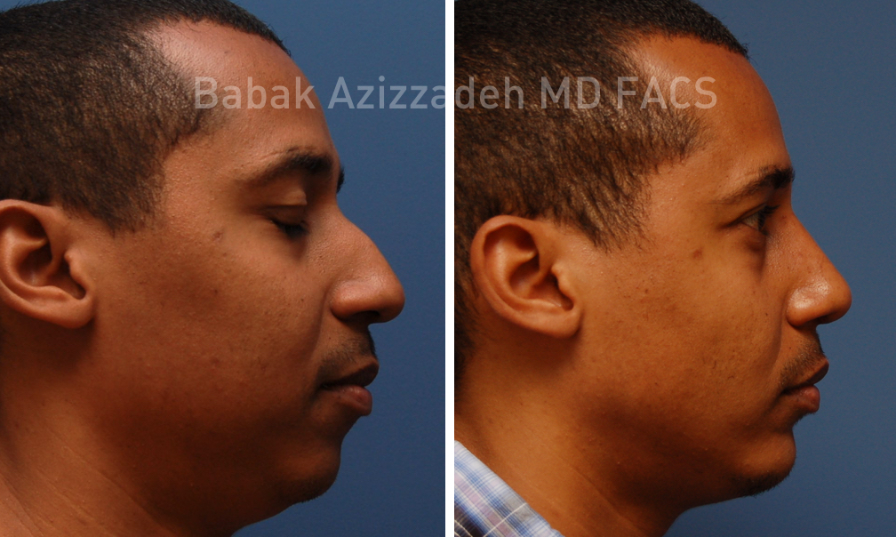 Male-Rhinoplasty-3-Before-After-Azizzadeh-Beverly-Hills.jpg
