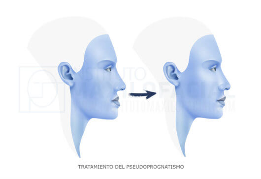 Pseudoprognathism, or maxillary hypoplasia: definition, causes and  treatments - Instituto Maxilofacial