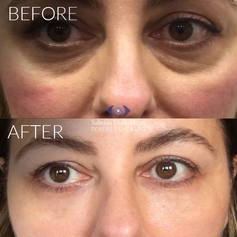 Tear-through-fillers-london-before-after1.jpg
